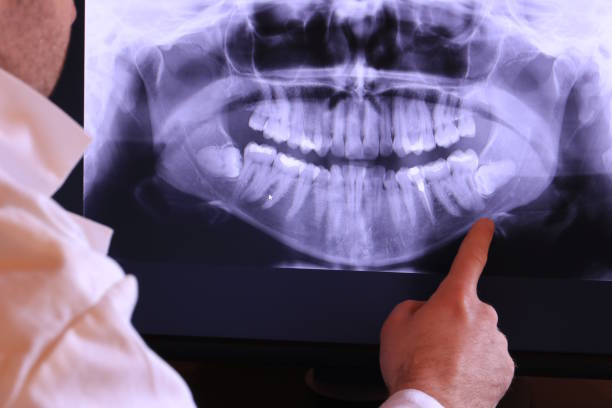 Best Emergency Tooth Extraction in Mendon, IL