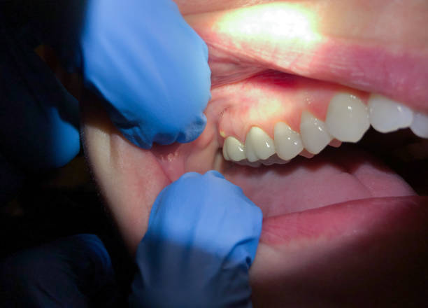 Best Emergency Dental Care for Broken or Chipped Teeth in Mendon, IL